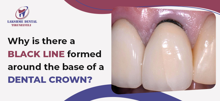 Why is there a black line formed around the base of a dental crown?