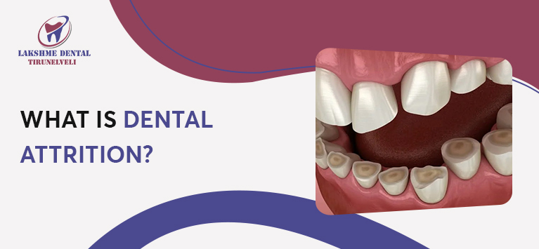 What is Dental Attrition?