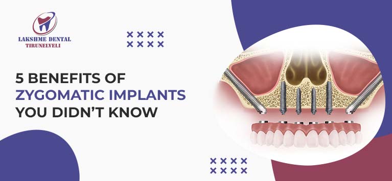 5 Benefits of Zygomatic Implants You Didn’t Know