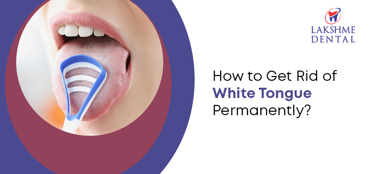 Home Remedies To Get Rid of White Tongue