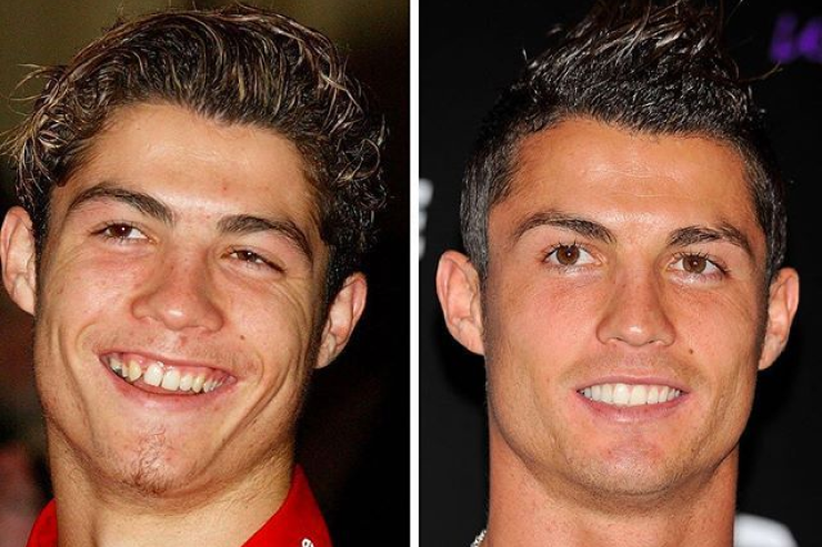 Cristiano Ronaldo - Celebrities Teeth Before After