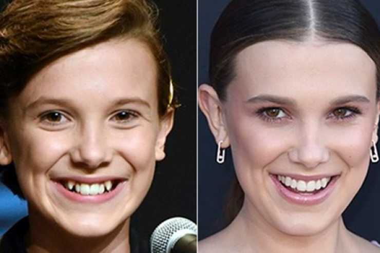 Millie Bobby Brown - Celebrities Teeth Before After