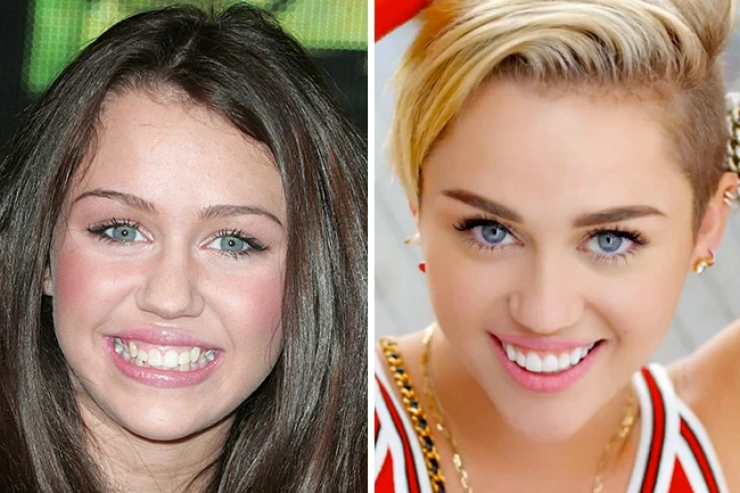 Miley Cyrus - Celebrities Teeth Before After