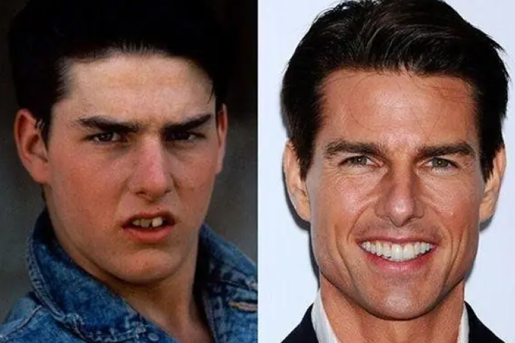 Tom Cruise - Celebrities Teeth Before After