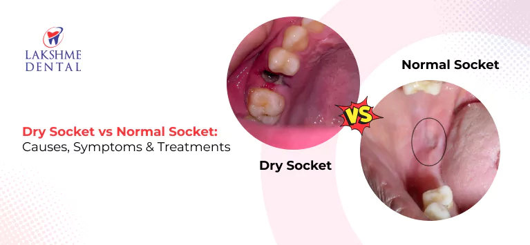 Dry Socket vs Normal Socket: Causes, Symptoms & Treatments