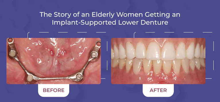 The Story of an Elderly Women Getting an Implant-Supported Lower Denture