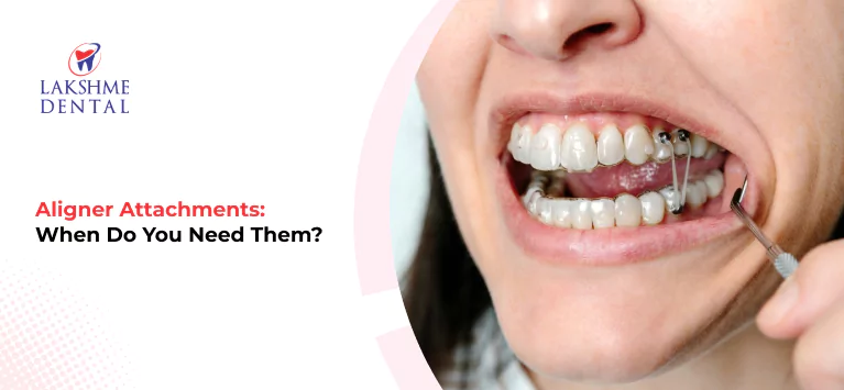 Aligner Attachments: When Do You Need Them?