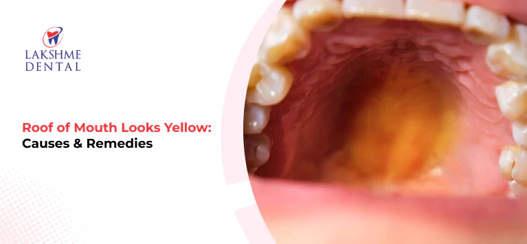 Roof of Mouth Looks Yellow: Causes & Remedies