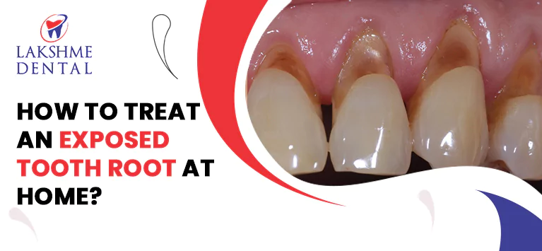 How to Treat an Exposed Tooth Root at Home