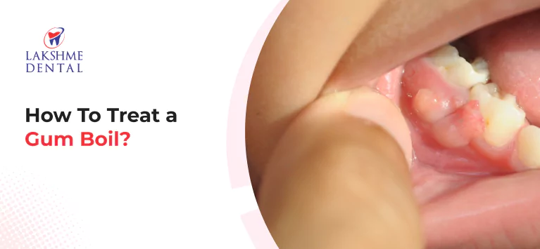 How To Treat a Gum Boil?