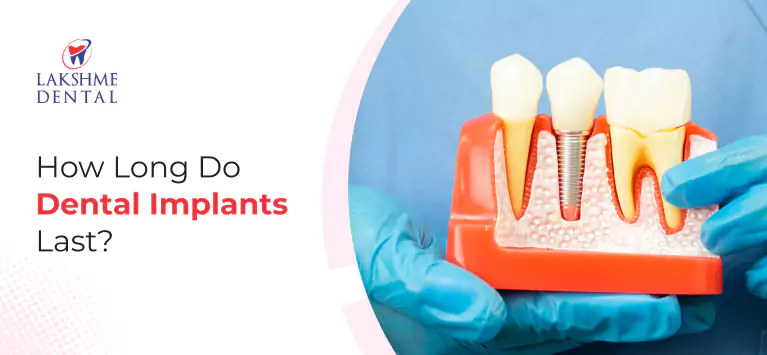 How Long Do Dental Implants Last?