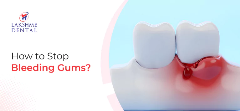 How to Stop Bleeding Gums?