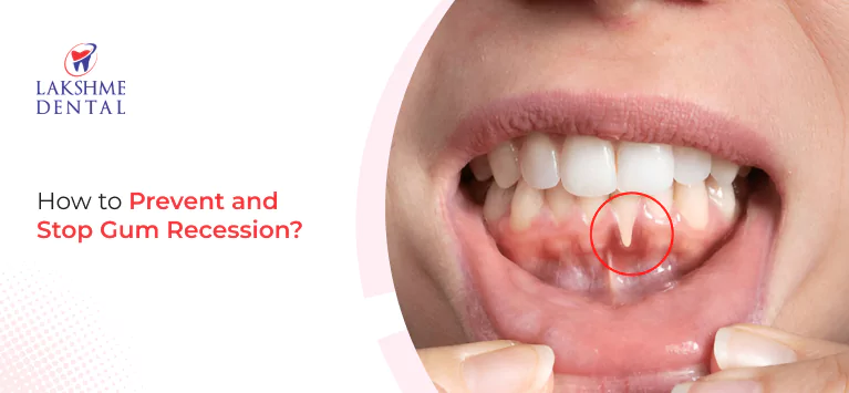 How to Prevent and Stop Gum Recession?